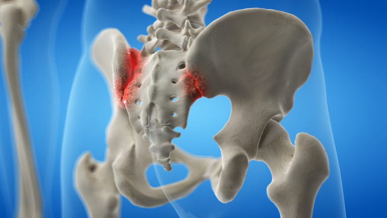 Sacroiliac Injection (SI) | Lone Star Pain Medicine